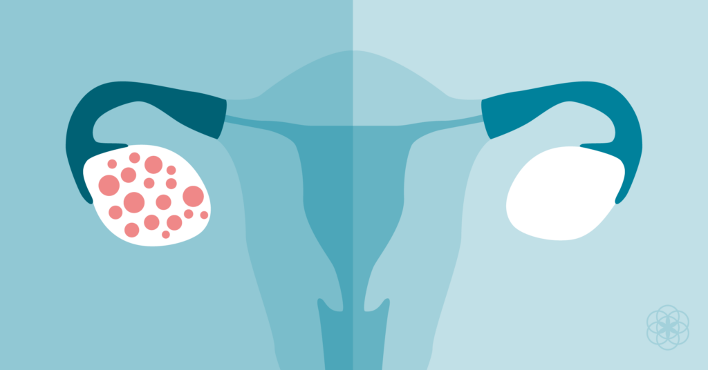 pcos_syndrom_polycystickych_ovarii