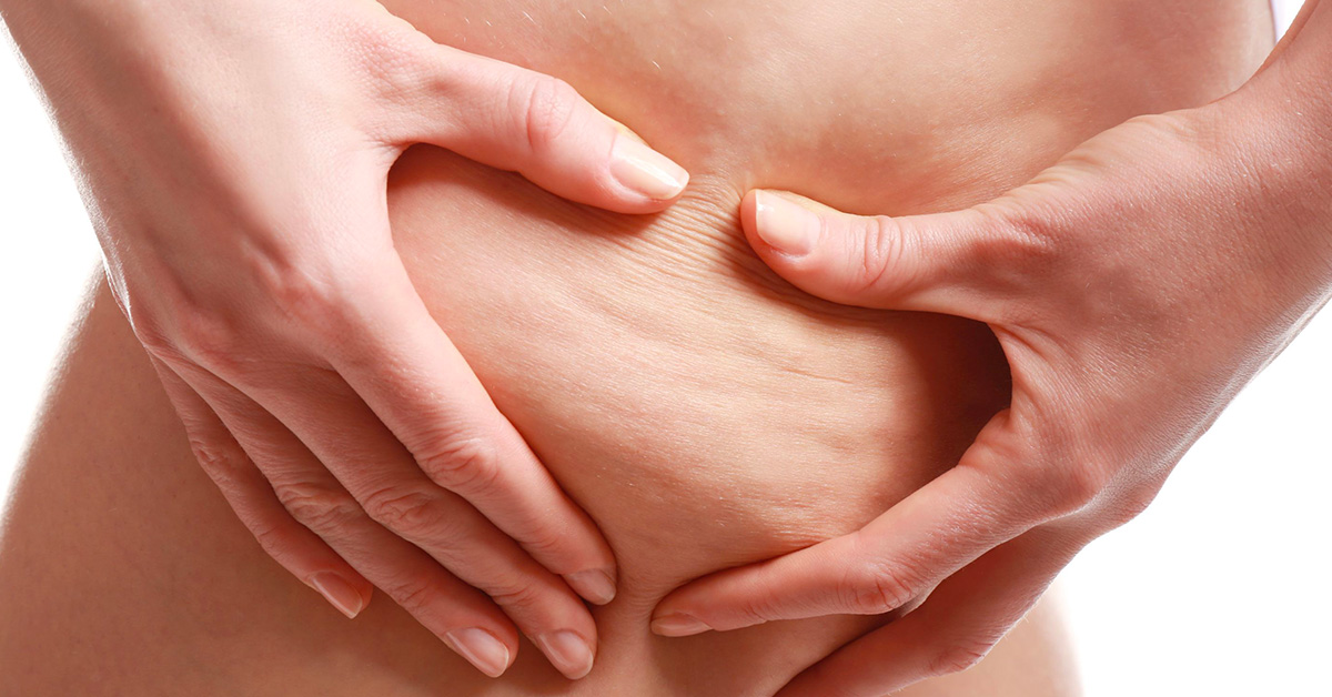 8 tipů v boji proti celulitidě