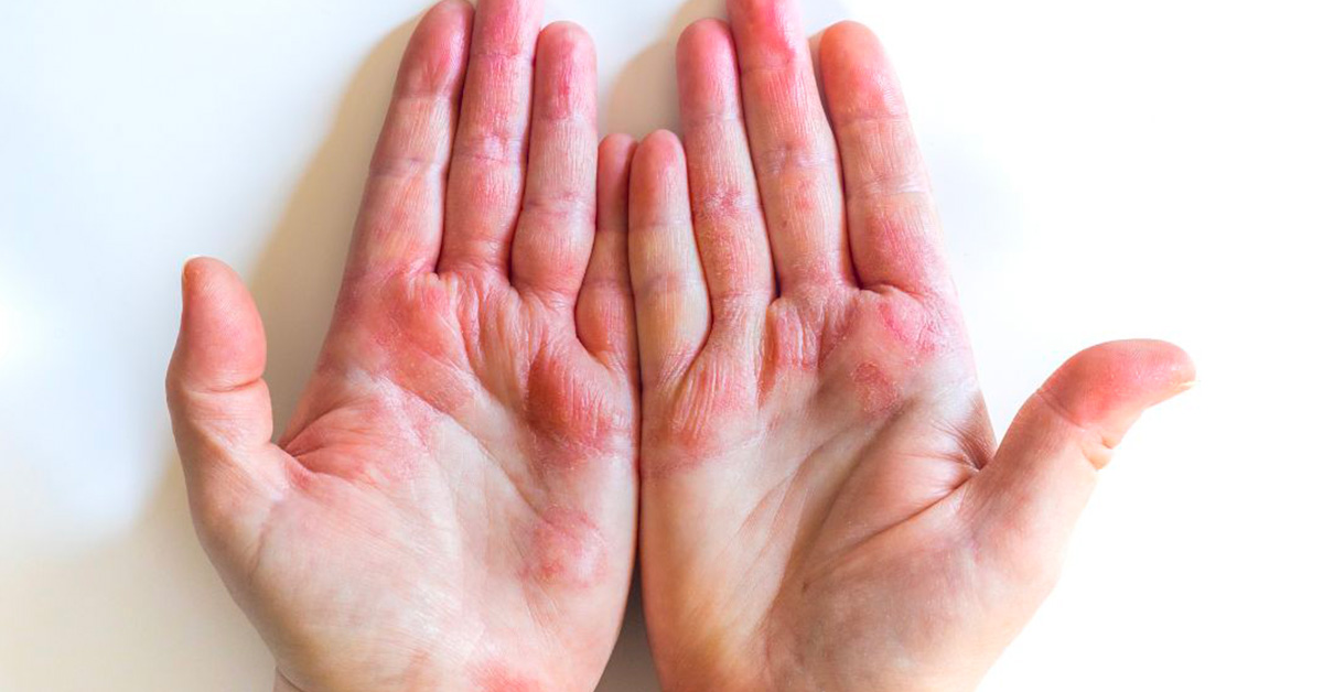 Atopický ekzém: onemocnění, které se netýká jen dětí