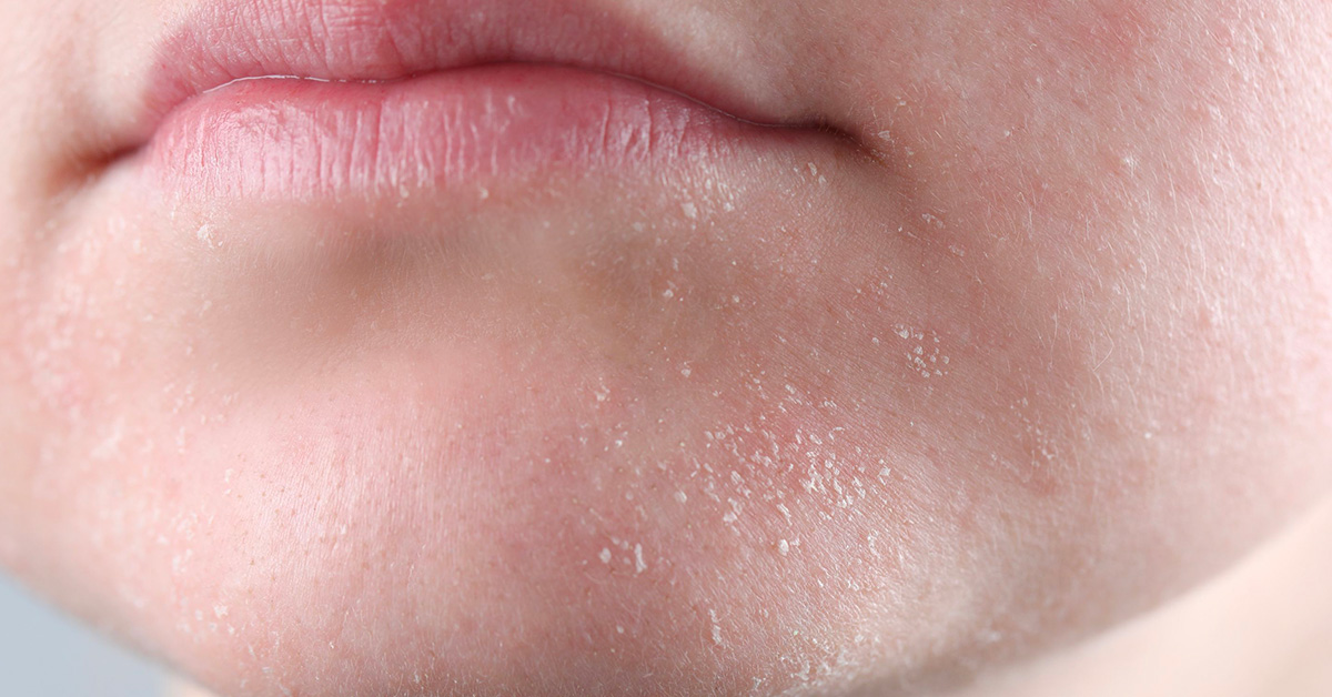 Dehydratovaná pleť: Jak ji odlišit od suché a správně o ni pečovat?