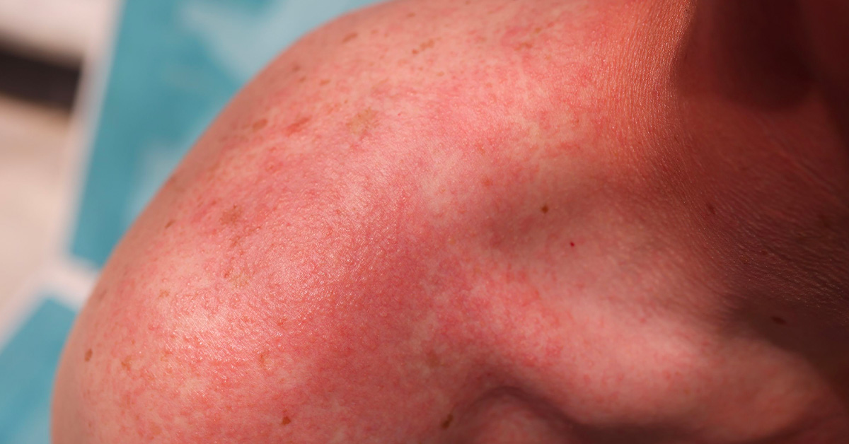 Desatero zdravého opalování