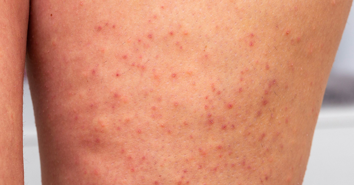 Jahodové nohy: Jak předcházet jejich vzniku?