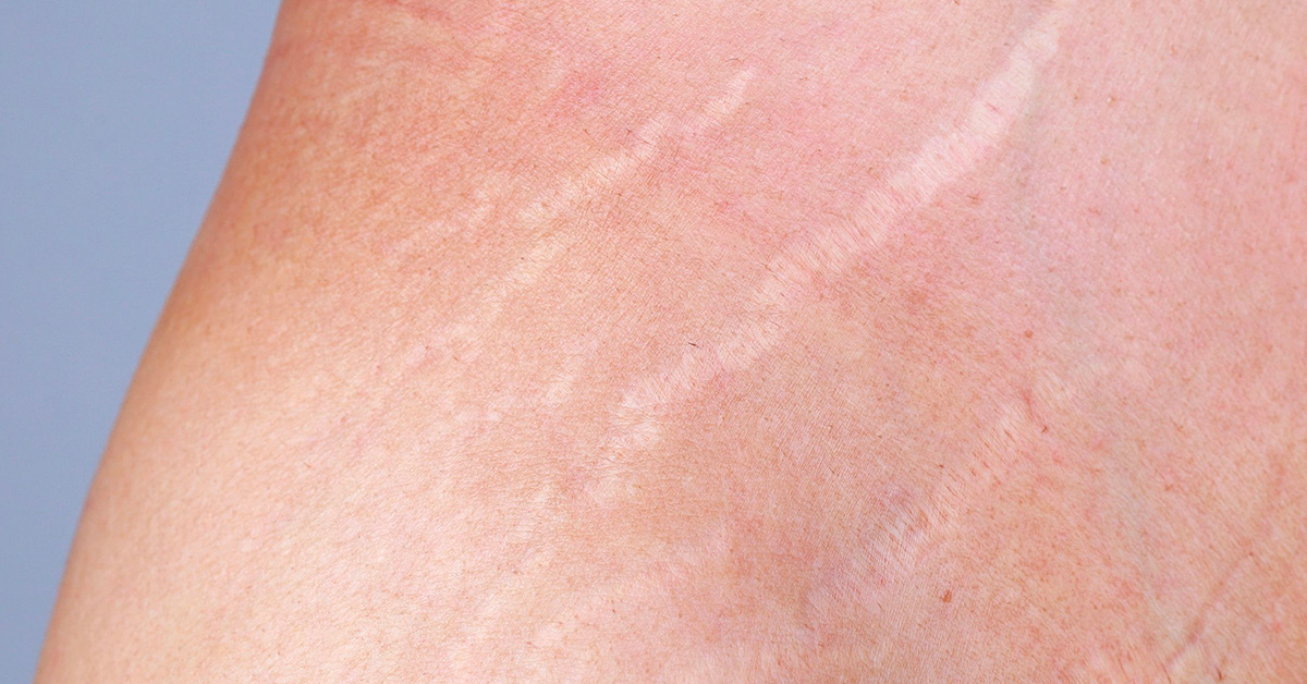 Jak předejít striím v těhotenství?