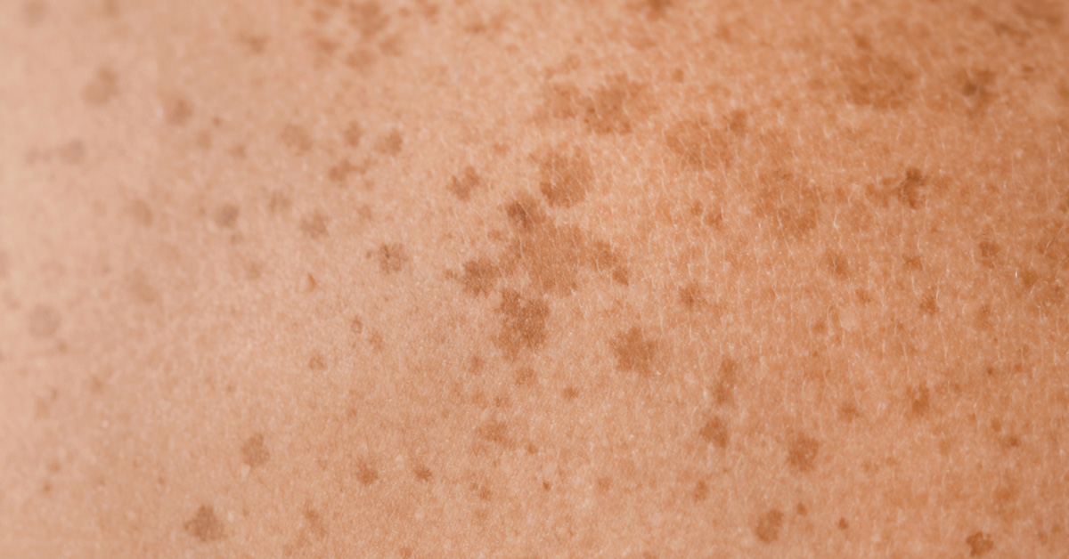 Pigmentové skvrny v těhotenství