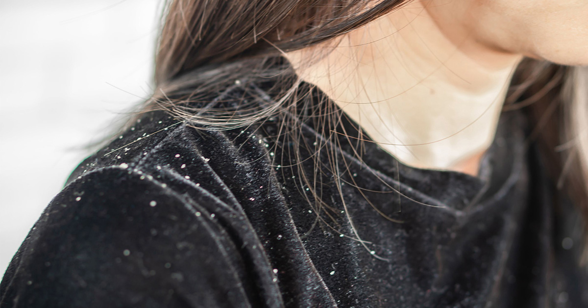 Suché vs. mastné lupy – jak je odlišit a zbavit se jich?