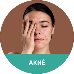 Akné