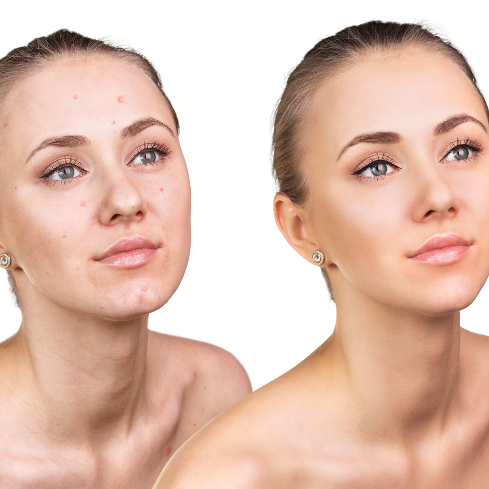 Una piel limpia y sin imperfecciones con Derminax: ideal para jóvenes y adultos