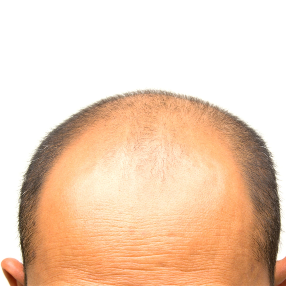 Follixin: apoya el crecimiento saludable del cabello y reduce la caída