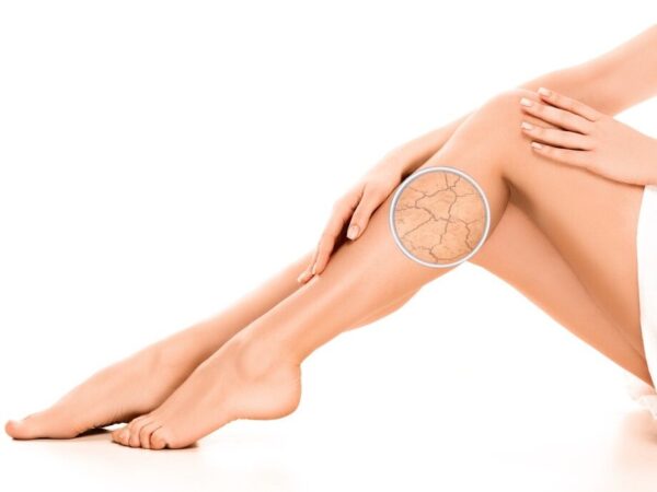 sucha-pokozka-edited-600x450