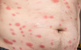  Червоні укуси клопів на животі