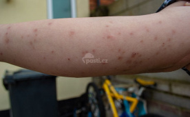  Передпліччя, повне укусів клопів
