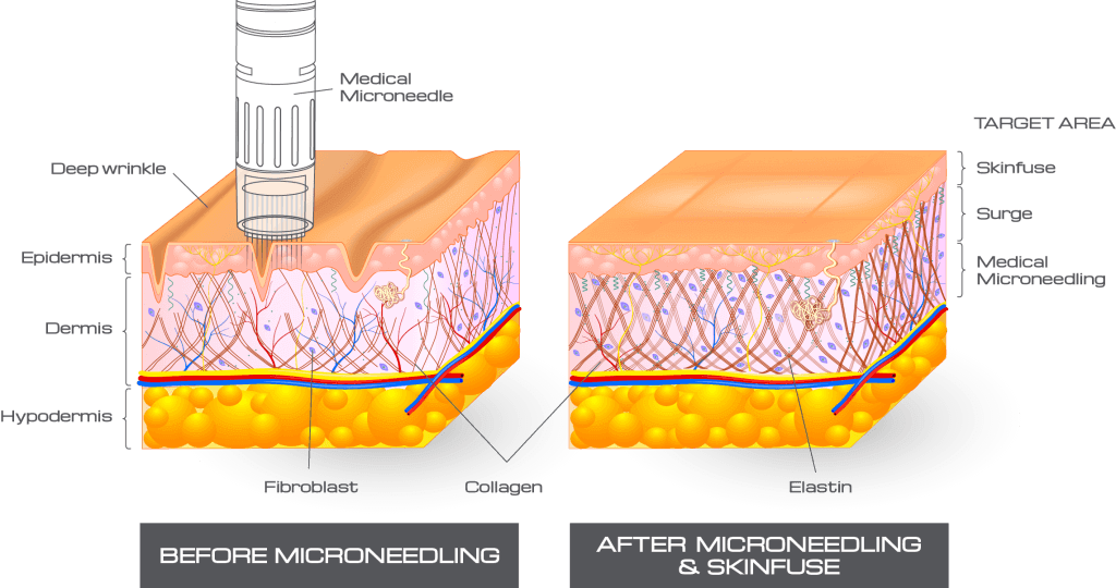 dermapen