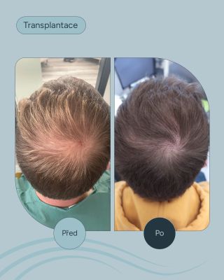 Transplantace ihned, výsledek na počkání? Tak to chodí jen v pohádkách. Transplantace vlasů je proces vyžadující čas a...