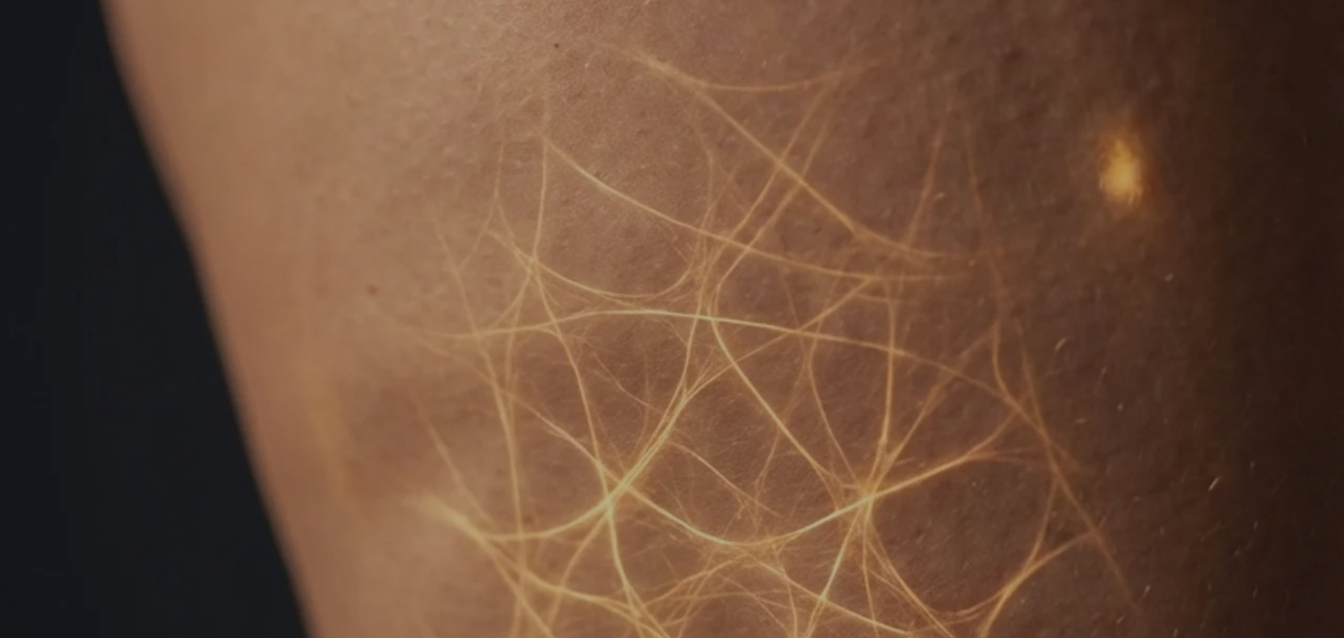 Proč mají celulitidu i štíhlé ženy