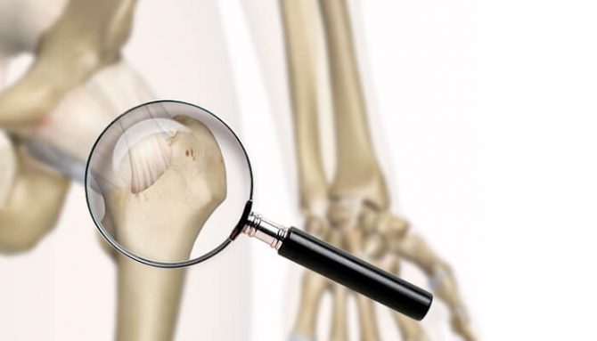 Prevenciou proti osteoporóze!