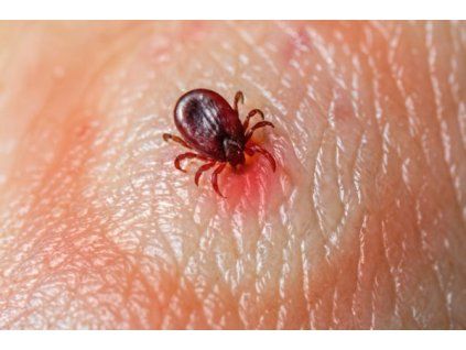 Lymeská borrelióza IgM a IgG