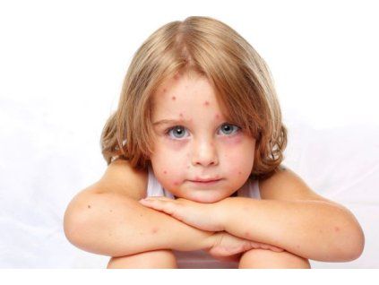 Plané neštovice (VZV) IgG