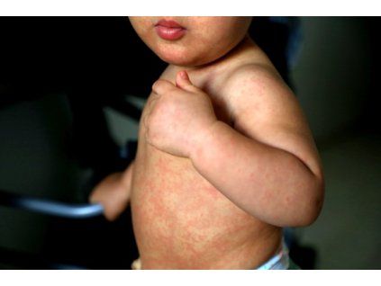 Zarděnky (Rubella)