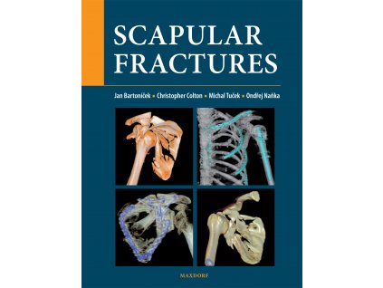 Scapular fractures Maxdorf 150
