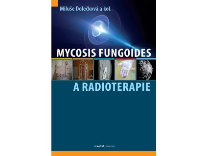 Mycosis fungoides a radioterapie Maxdorf 150