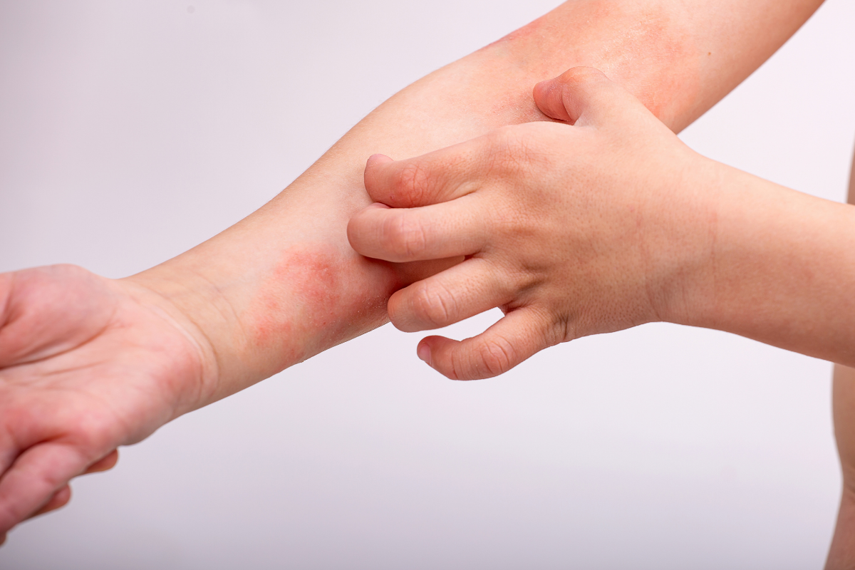 Eczema și dermatita atopică: De ce merită să apelați la un dermonutraceutic