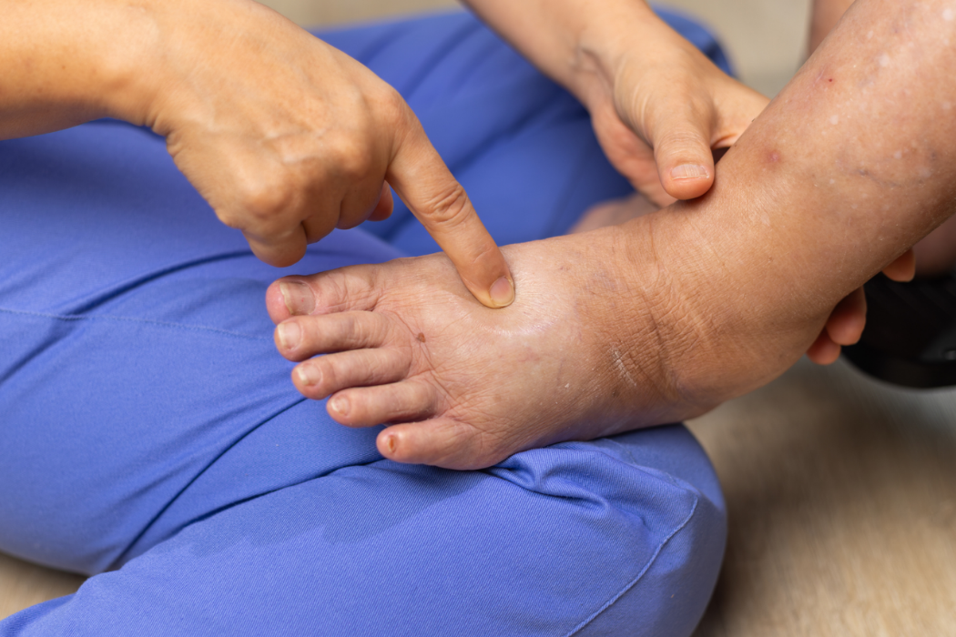Diabetická noha: Jak se chránit před komplikacemi cukrovky