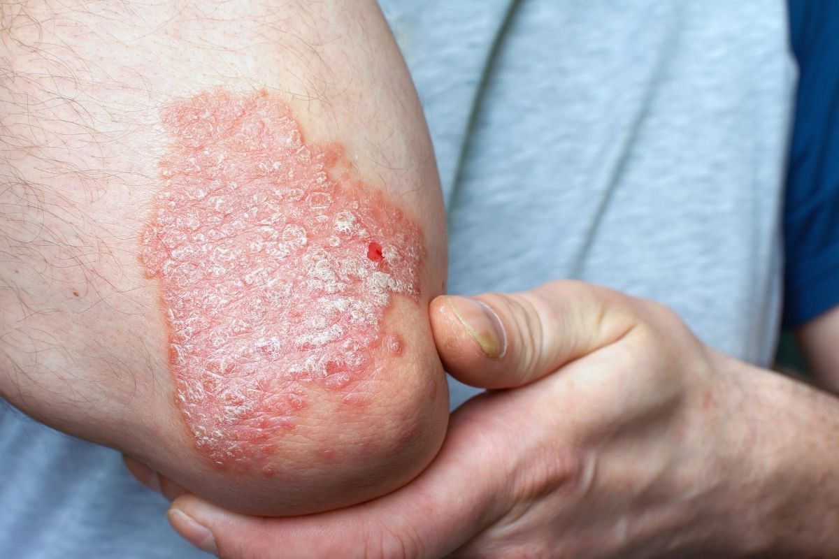 Lupénka (PSORIÁZA) – imunitní onemocnění, které nepostihuje jen pokožku, ale i klouby