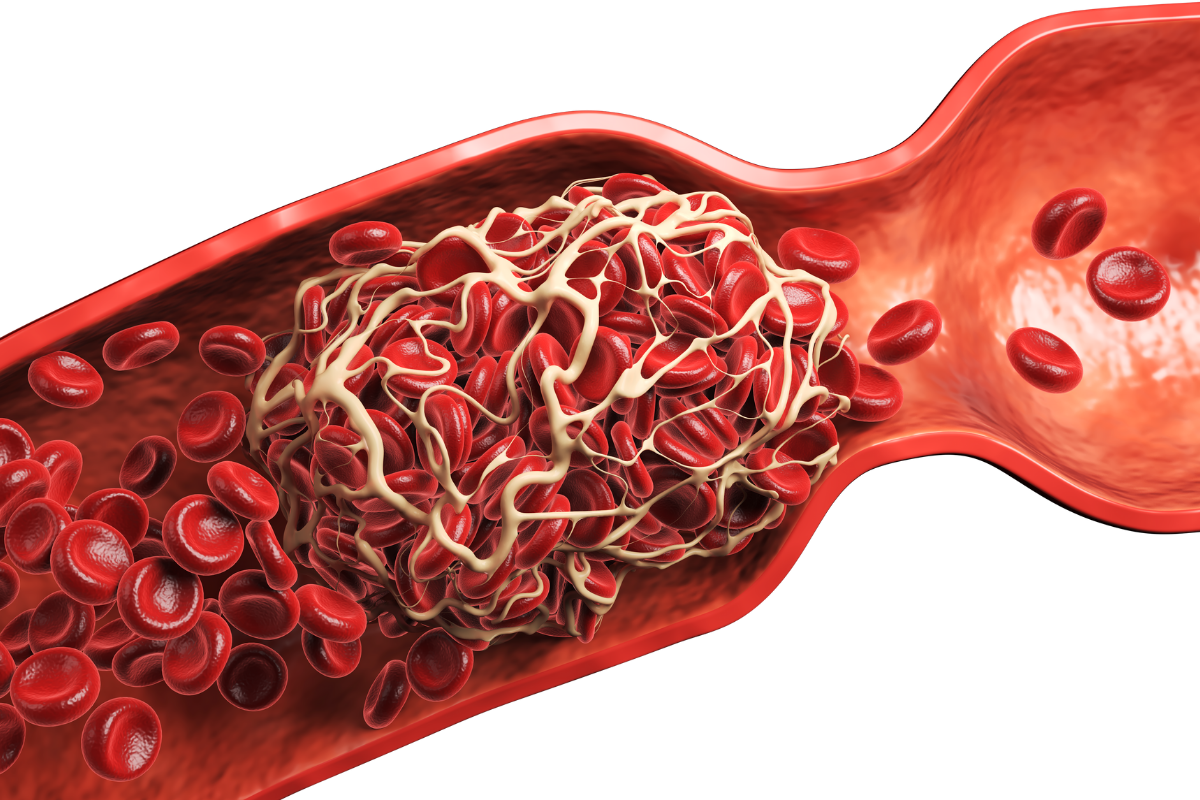 „Ucpané“ cévy představují mnohem vyšší riziko mrtvice nebo infarktu než zvýšená hladina cholesterolu v krvi.
