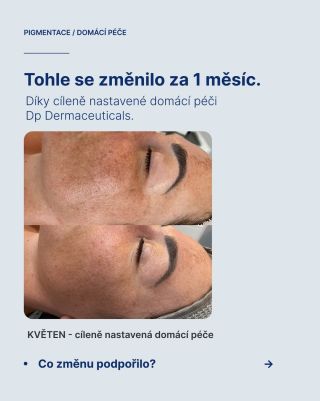 Některé typy pigmentací umí být velmi vytrvalé a málokdy reagují na jedno jednoduché řešení. Je to cesta o důslednosti,...