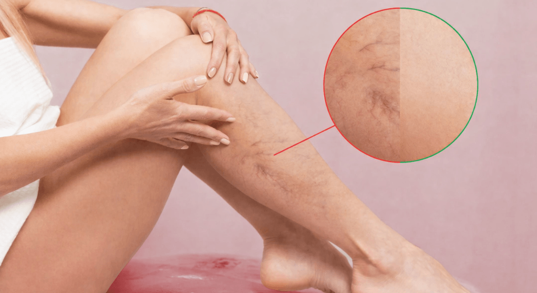 Čo na kŕčové žily? Pozreli sme sa na zloženie prípravku Varivenol a na výhody kapsúl voči tabletám