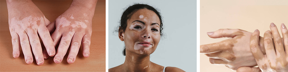 vitiligo-foto