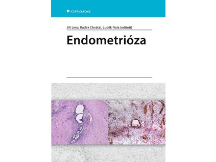 124499 endometrioza