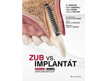 Zub vs. implantát - Zachovat, či nahradit vážně poškozený zub?