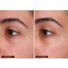 1155 3 before and after v1 clinical results biolumin c gel moisturizer