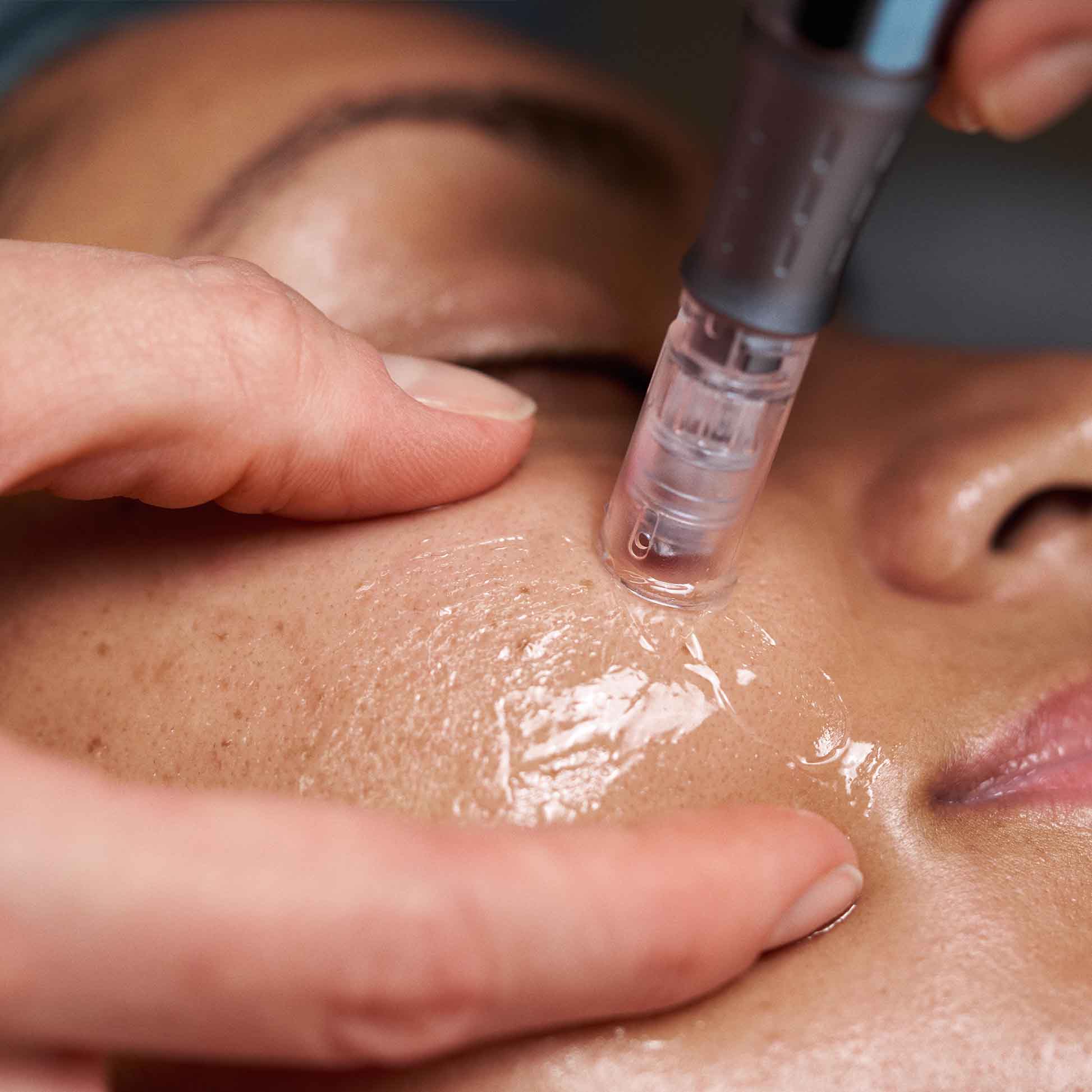 Microneedling"