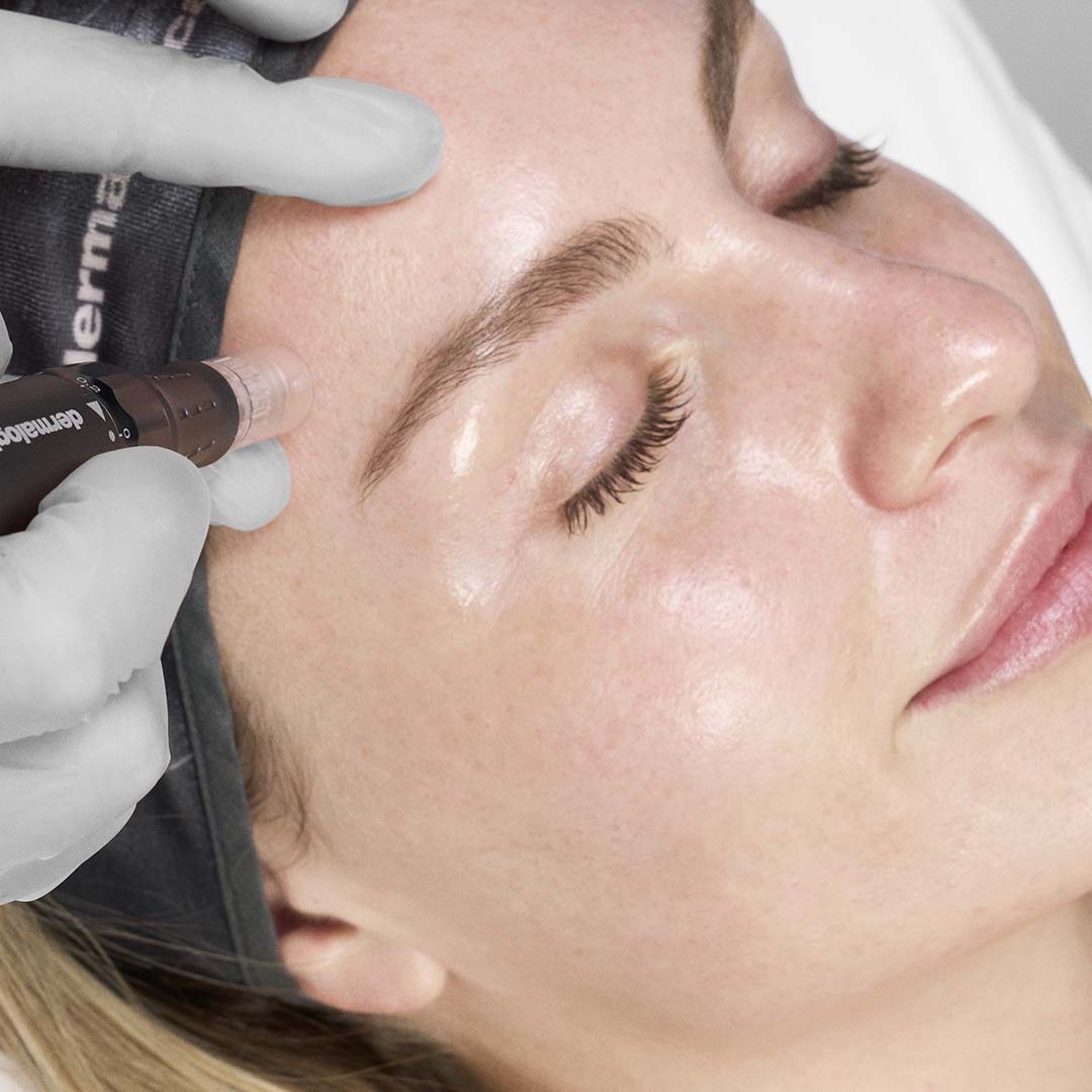 Microneedling