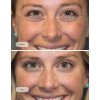Smooth away wrinkles with Botox