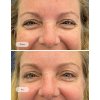 Smooth away wrinkles with Botox