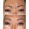 Smooth away wrinkles with Botox