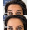 Smooth away wrinkles with Botox