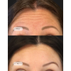 Botox čelo