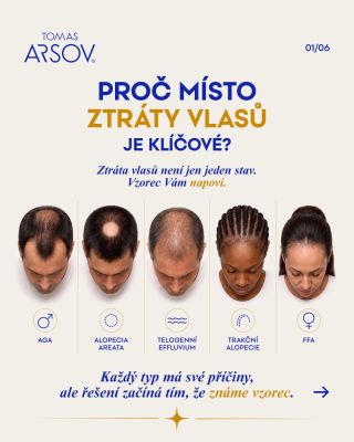 ✔ 5 nejčastějších typů ztráty vlasů a jak je od sebe poznat ✔️ Proč lokalita vypadávání prozradí příčinu dřív než cokoli...