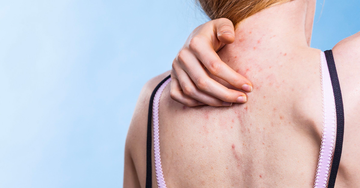 Akné na chrbte: Čo ho zapríčiňuje a ako sa ho zbaviť?