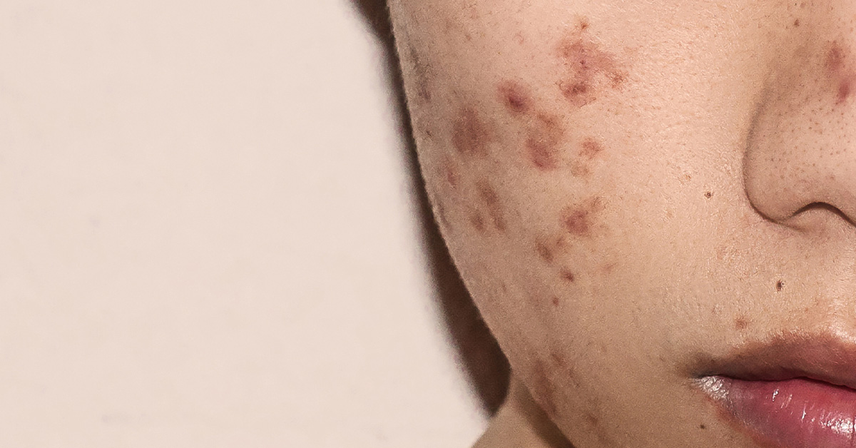 Pigmentové škvrny na tvári