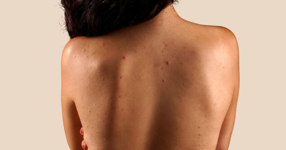 Akné na chrbte: Prečo sa tvorí a 3 kľúčové rady, ako sa ho zbaviť