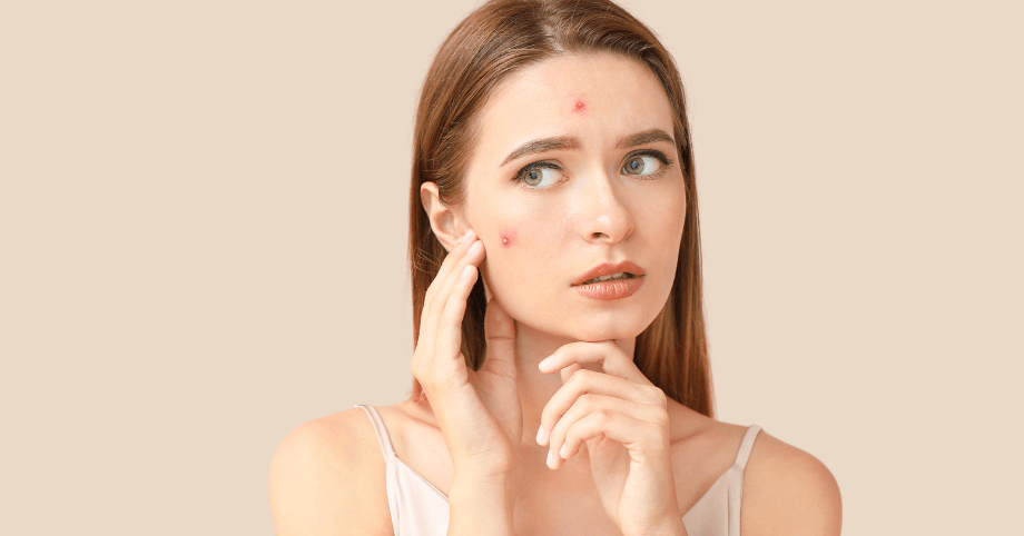 5 jednoduchých zmien a 1 kľúčová rada, ktoré vám pomôžu v boji proti akné
