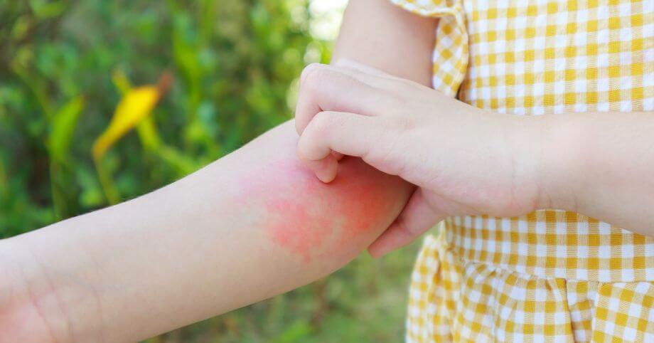 Atopický ekzém: 5 tipov, ktoré pomáhajú zmierniť svrbenie pokožky