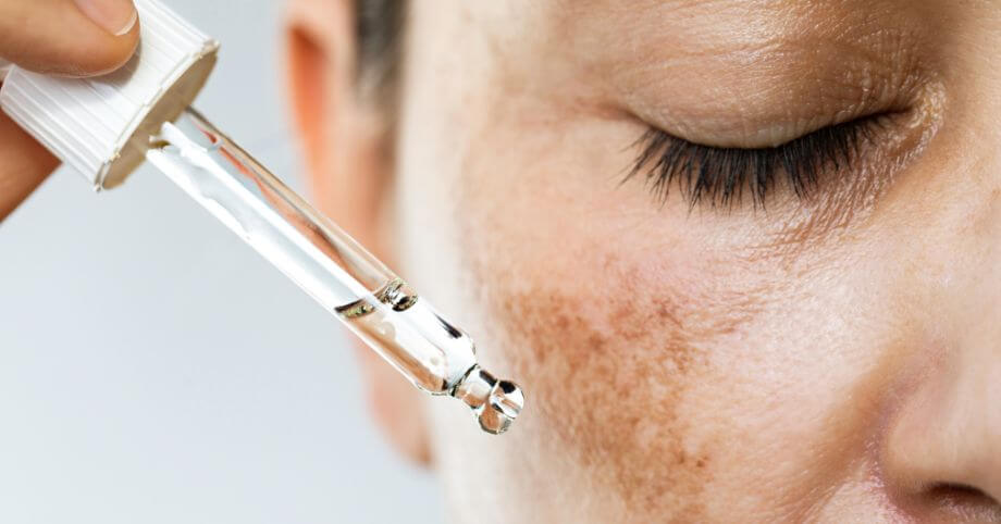 Pigmentové škvrny na tvári