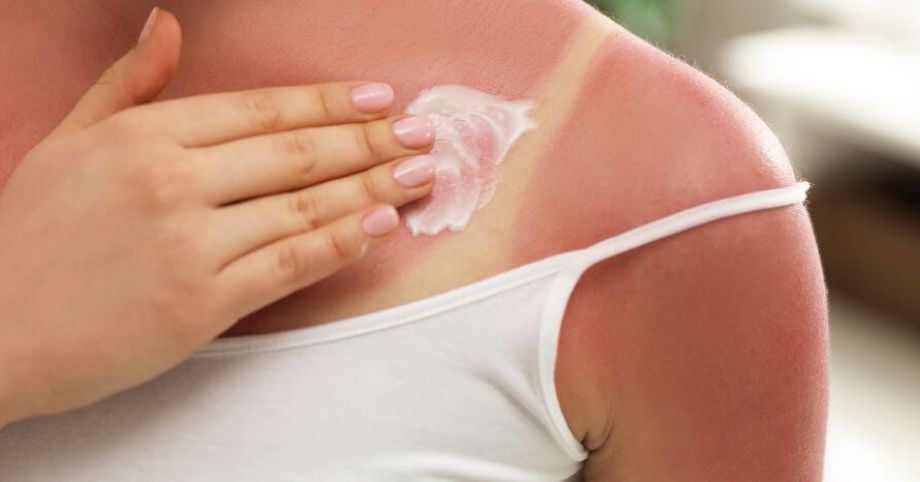 Prvá pomoc pre pokožku spálenú od slnka