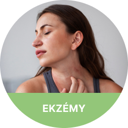 Ekzémy